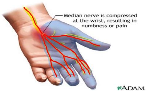 median nerve injury sign